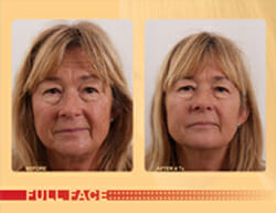 Exilis™ For Facial Rejuvenation Before and After NJ