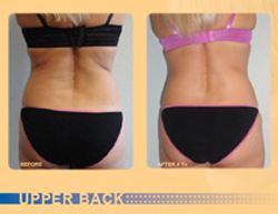 Exilis™ Before and After NJ