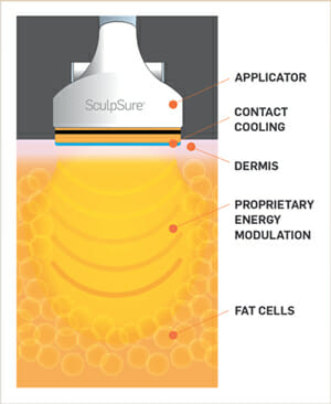 SculpSure MOA