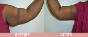 Arm Lift Gallery