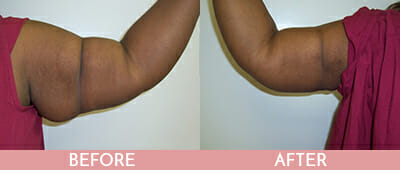 Arm Lift Before and After, Montclair, NJ and New York (NY)
