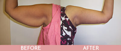 Arm Lift Before and After, Montclair, NJ and New York (NY)