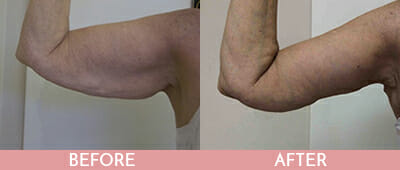 Arm Lift Before and After, Montclair, NJ and New York (NY)