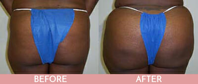Brazilian Butt Lift Before and After, Montclair, NJ and New York (NY)