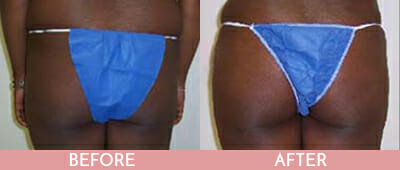 Brazilian Butt Lift Before and After, Montclair, NJ and New York (NY)