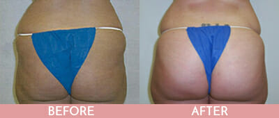 Brazilian Butt Lift Before and After, Montclair, NJ and New York (NY)