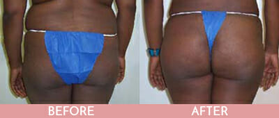 Brazilian Butt Lift Before and After, Montclair, NJ and New York (NY)