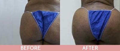 Brazilian Butt Lift Before and After, Montclair, NJ and New York (NY)
