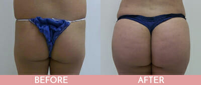 Brazilian Butt Lift Before and After, Montclair, NJ and New York (NY)