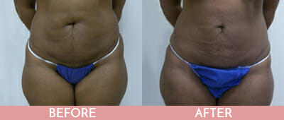 Brazilian Butt Lift Before and After, Montclair, NJ and New York (NY)