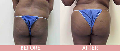 Brazilian Butt Lift Before and After, Montclair, NJ and New York (NY)