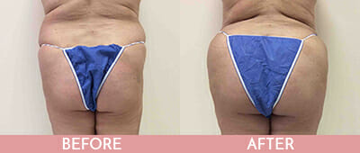 Brazilian Butt Lift Before and After, Montclair, NJ and New York (NY)