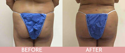 Brazilian Butt Lift Before and After, Montclair, NJ and New York (NY)