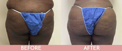 Brazilian Butt Lift Before and After, Montclair, NJ and New York (NY)