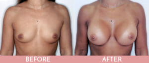 Breast Augmentation Gallery