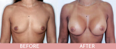 Breast Augmentation Before and After, Montclair, NJ and New York (NY)