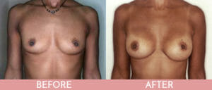 Breast Augmentation Gallery