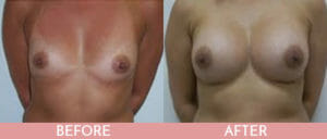 Breast Augmentation Gallery