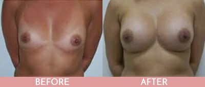 Breast Augmentation Before and After, Montclair, NJ and New York (NY)