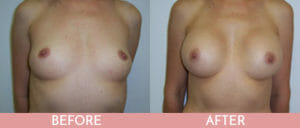 Breast Augmentation Gallery