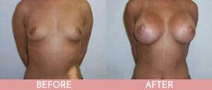 Breast Augmentation Gallery
