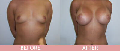 Breast Augmentation Before and After, Montclair, NJ and New York (NY)
