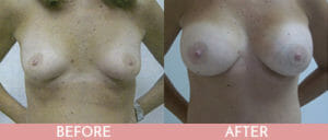 Breast Augmentation Gallery