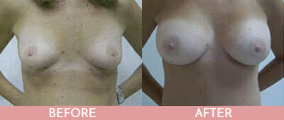Breast Augmentation Before and After, Montclair, NJ and New York (NY)