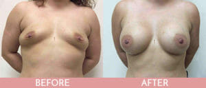 Breast Augmentation Gallery