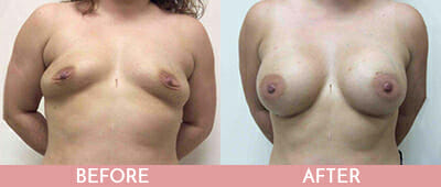 Breast Augmentation Before and After, Montclair, NJ and New York (NY)