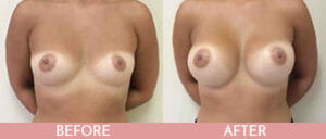 Breast Augmentation Gallery