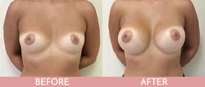 Breast Augmentation Before and After, Montclair, NJ and New York (NY)