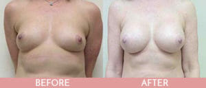 Breast Augmentation Gallery