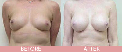 Breast Augmentation Before and After, Montclair, NJ and New York (NY)
