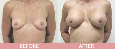 Breast Augmentation Before and After, Montclair, NJ and New York (NY)