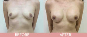 Breast Augmentation Gallery