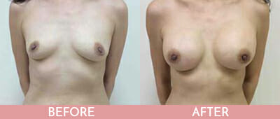 Breast Augmentation Before and After, Montclair, NJ and New York (NY)