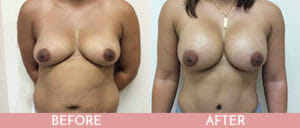 Breast Augmentation Gallery