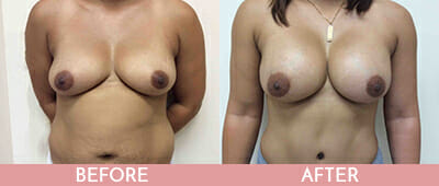 Breast Augmentation Before and After, Montclair, NJ and New York (NY)
