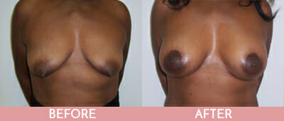 Breast Lift Before and After, Montclair, NJ and New York (NY)