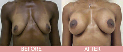 Breast Lift Before and After, Montclair, NJ and New York (NY)