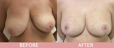 Breast Lift Before and After, Montclair, NJ and New York (NY)
