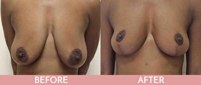 Breast Lift Before and After, Montclair, NJ and New York (NY)