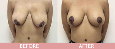 Breast Lift Before and After, Montclair, NJ and New York (NY)