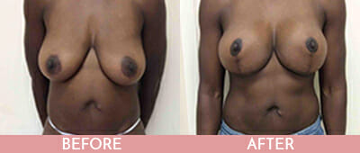 Breast Lift Before and After, Montclair, NJ and New York (NY)