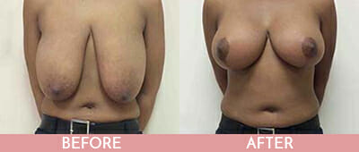 Breast Lift Before and After, Montclair, NJ and New York (NY)