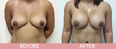 Breast Lift Before and After, Montclair, NJ and New York (NY)