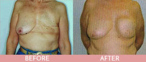 Breast Reconstruction Gallery