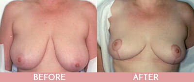 Breast Reduction Before and After, Montclair, NJ and New York (NY)