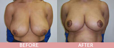 Breast Reduction Before and After, Montclair, NJ and New York (NY)